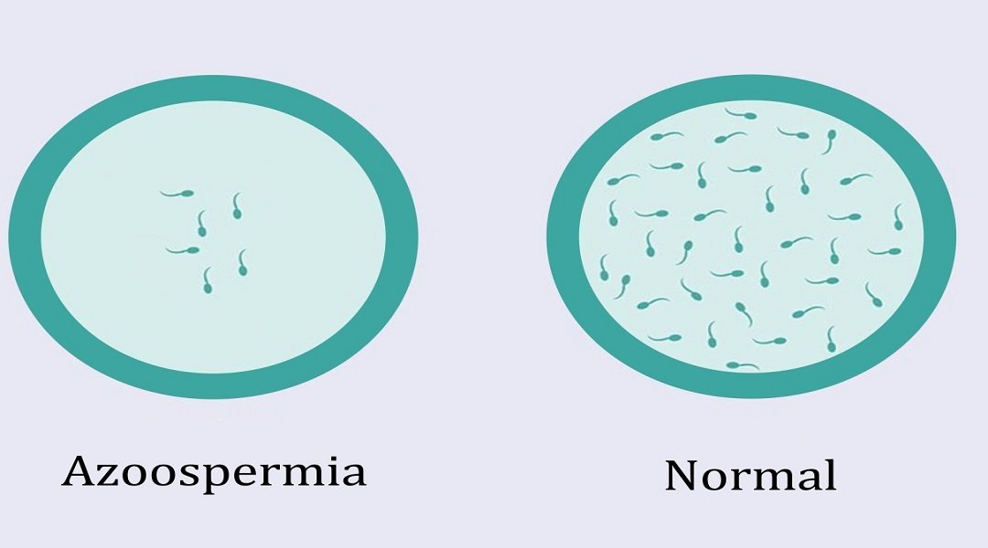 Best Medicine For Azoospermia In Nagpur