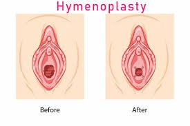 Hymenoplasty In Nagpur