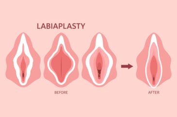 Labiaplasty In Nagpur