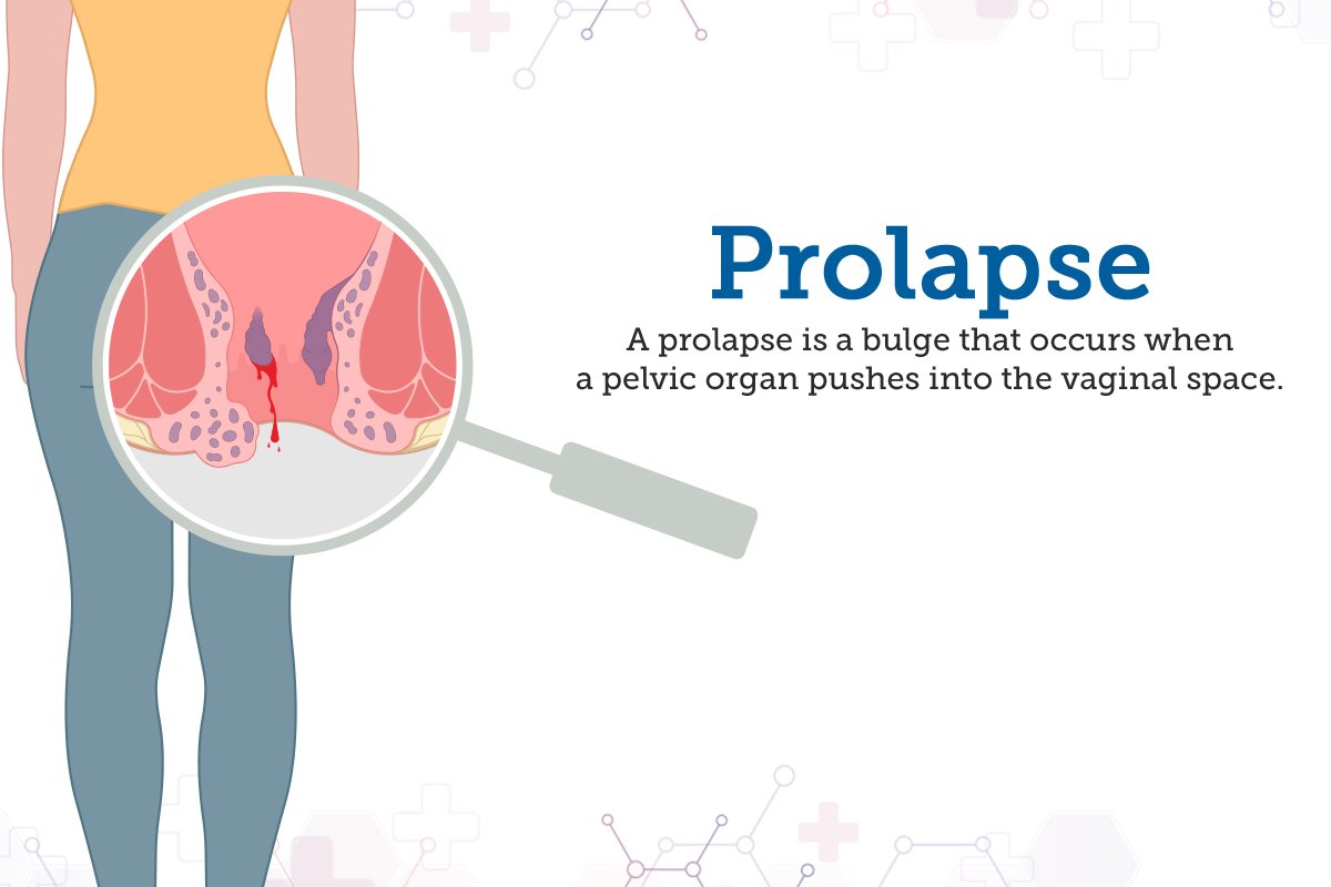 Vaginal prolapse treatment in nagpur