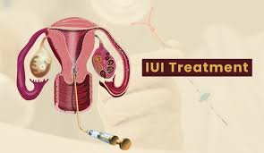 Best IUI Center near me In Jabalpur