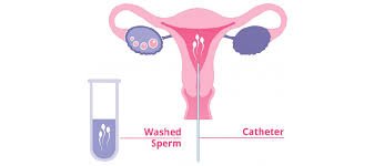 Best IUI Center near me In Raipur