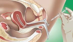 Best Semen Preparation Center For IUI In Jabalpur