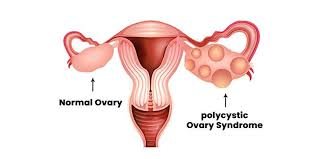 Female Infertility Treatment For PCOS/PCOD In Jabalpur