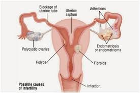 Treatment Of Endometriosis In Infertile Female In Jabalpur