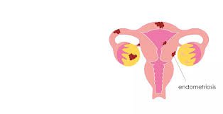 Treatment Of Endometriosis In Infertile Female In Raipur